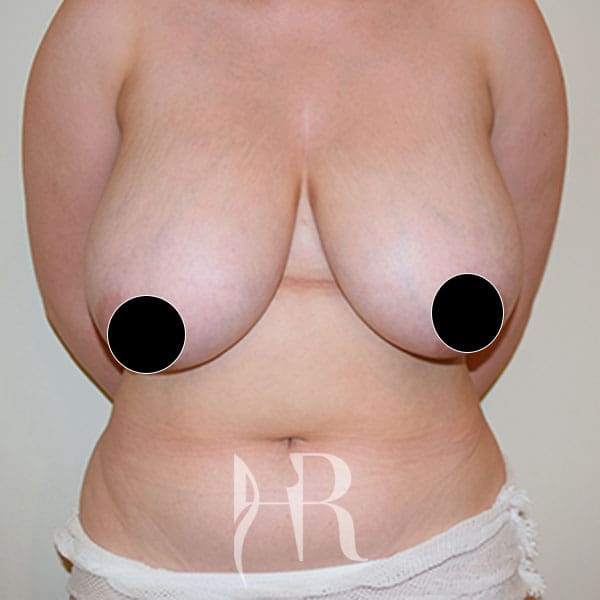 HR Plastic Surgery - Breast Reduction patient before 11