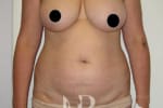HR Plastic Surgery - Breast Reconstruction patient before 4