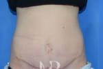 HR Plastic Surgery - Diastasis Recti Surgery patient after 1