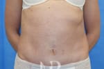 HR Plastic Surgery - Diastasis Recti Surgery patient after 3