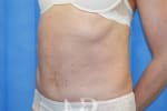 HR Plastic Surgery - Diastasis Recti Surgery patient after 4