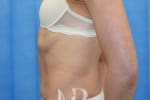HR Plastic Surgery - Diastasis Recti Surgery patient after 5
