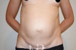 HR Plastic Surgery - Diastasis Recti Surgery patient before 3