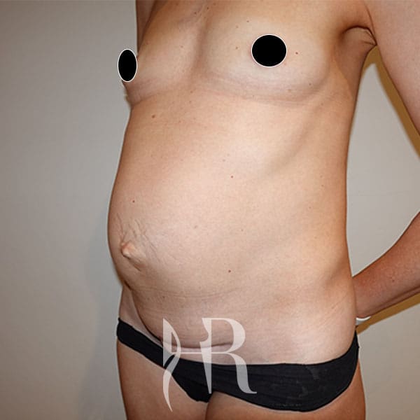 HR Plastic Surgery - Diastasis Recti Surgery patient before 4