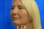 HR Plastic Surgery - Facelift patient after 1
