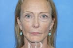 HR Plastic Surgery - Facelift patient after 2