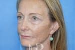 HR Plastic Surgery - Facelift patient after 3