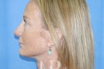 HR Plastic Surgery - Facelift patient after 4