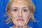 HR Plastic Surgery - Facelift patient after 5