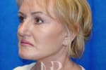 HR Plastic Surgery - Facelift patient after 6
