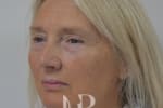 HR Plastic Surgery - Facelift patient before 1