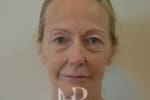 HR Plastic Surgery - Facelift patient before 2