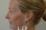 HR Plastic Surgery - Facelift patient before 4