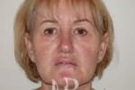 HR Plastic Surgery - Facelift patient before 5
