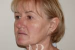 HR Plastic Surgery - Facelift patient before 6