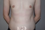 HR Plastic Surgery - Male Breast Reduction patient after 1