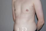 HR Plastic Surgery - Male Breast Reduction patient after 2
