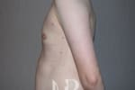 HR Plastic Surgery - Male Breast Reduction patient after 3