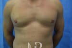 HR Plastic Surgery - Male Breast Reduction patient after 4