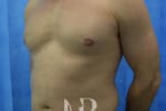 HR Plastic Surgery - Male Breast Reduction patient after 5