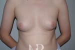 HR Plastic Surgery - Male Breast Reduction patient before 1