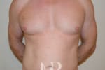 HR Plastic Surgery - Male Breast Reduction patient before 4