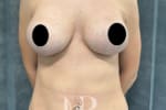HR Plastic Surgery - Internal Mesh Bra Lift patient after 1