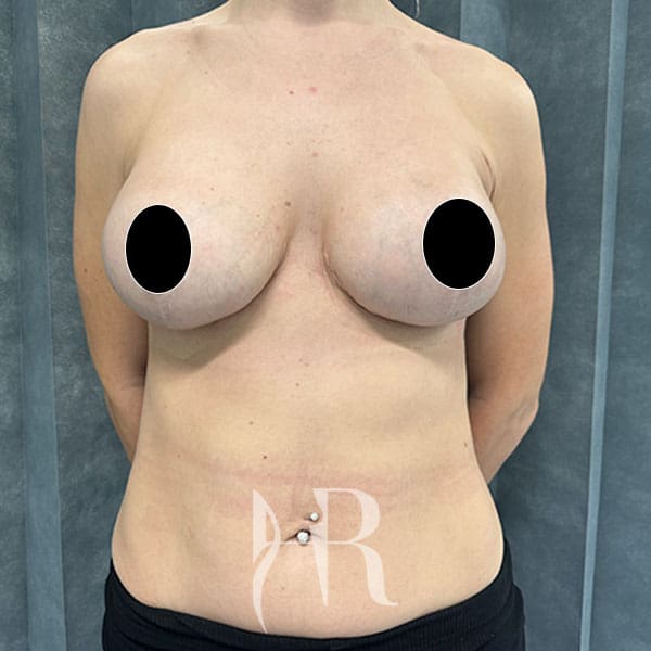 HR Plastic Surgery - Internal Mesh Bra Lift patient after 1