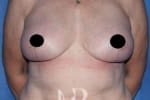HR Plastic Surgery - Breast Uplift patient after 3