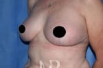 HR Plastic Surgery - Breast Uplift patient after 2
