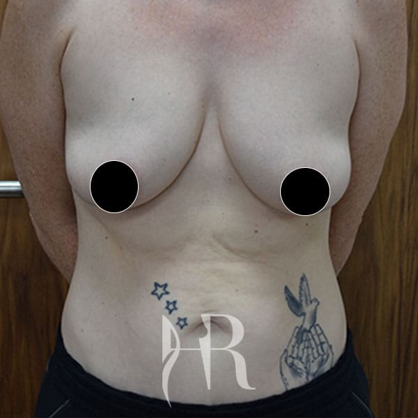 HR Plastic Surgery - Breast Uplift patient before 14