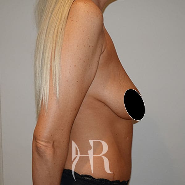 HR Plastic Surgery - Breast Uplift patient before 10