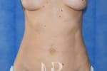 HR Plastic Surgery - Mini Tummy Tuck patient before 1