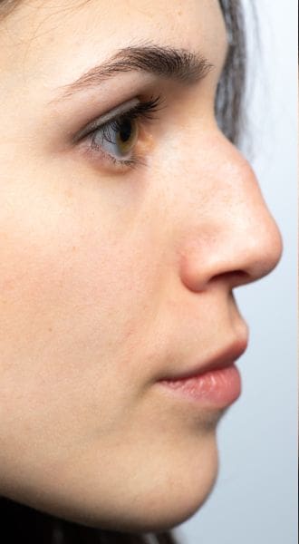 HR Plastic Surgery - Misshapen nose