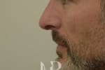HR Plastic Surgery - Nose Reshaping (Rhinoplasty) patient after 1