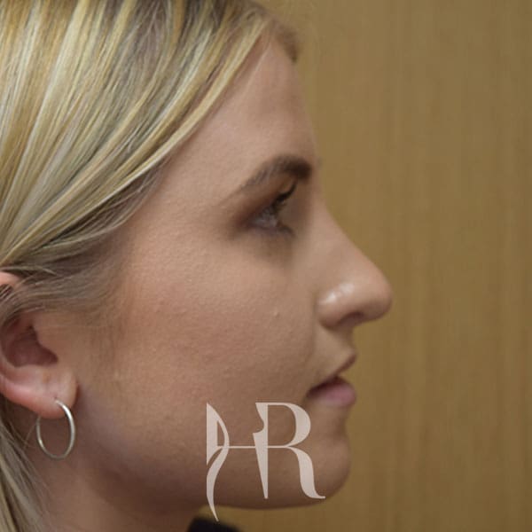HR Plastic Surgery - Nose Reshaping (Rhinoplasty) patient after 13