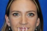HR Plastic Surgery - Nose Reshaping (Rhinoplasty) patient after 14