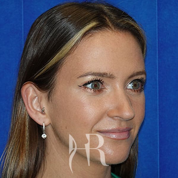 HR Plastic Surgery - Nose Reshaping (Rhinoplasty) patient after 15