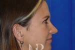 HR Plastic Surgery - Nose Reshaping (Rhinoplasty) patient after 16