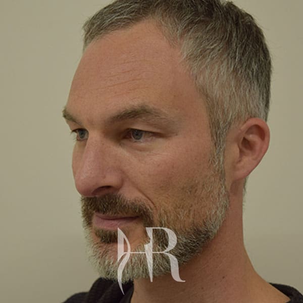 HR Plastic Surgery - Nose Reshaping (Rhinoplasty) patient after 2