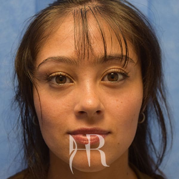 HR Plastic Surgery - Nose Reshaping (Rhinoplasty) patient after 5