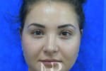 HR Plastic Surgery - Nose Reshaping (Rhinoplasty) patient after 7