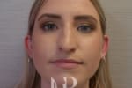 HR Plastic Surgery - Nose Reshaping (Rhinoplasty) patient before 11