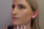 HR Plastic Surgery - Nose Reshaping (Rhinoplasty) patient before 12