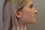 HR Plastic Surgery - Nose Reshaping (Rhinoplasty) patient before 13