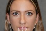 HR Plastic Surgery - Nose Reshaping (Rhinoplasty) patient before 14