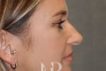 HR Plastic Surgery - Nose Reshaping (Rhinoplasty) patient before 16