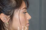 HR Plastic Surgery - Nose Reshaping (Rhinoplasty) patient before 6