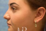 HR Plastic Surgery - Nose Reshaping (Rhinoplasty) patient before 9