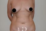 HR Plastic Surgery - Tummy Tuck patient before 1